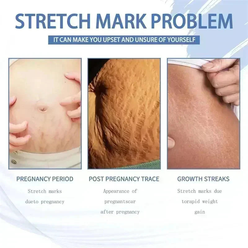 Removes Stretch Mark Cream To Remove Postpartum Obesity Pregnant Women Repair Anti-Aging Winkles Firming Body Cream Skin Care